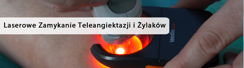 https://europejskiecentrumflebologii.pl/ptoosunu/laserowe-zamykanie-teleangiektazji-i-zylakow-1.jpg